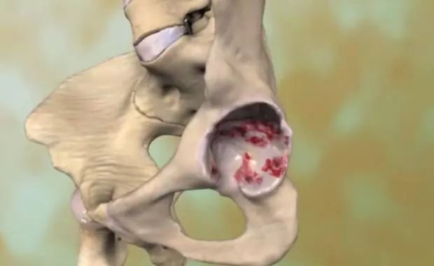 髋关节疼有哪几种原因,髋关节痛如何能确诊什么原因引起