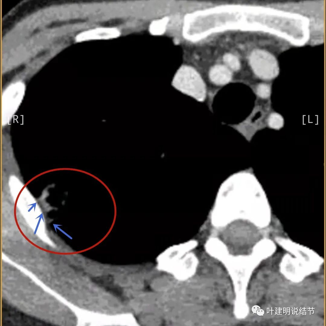 临床诊断孤立性肺结节,空洞型结节一般是什么性质