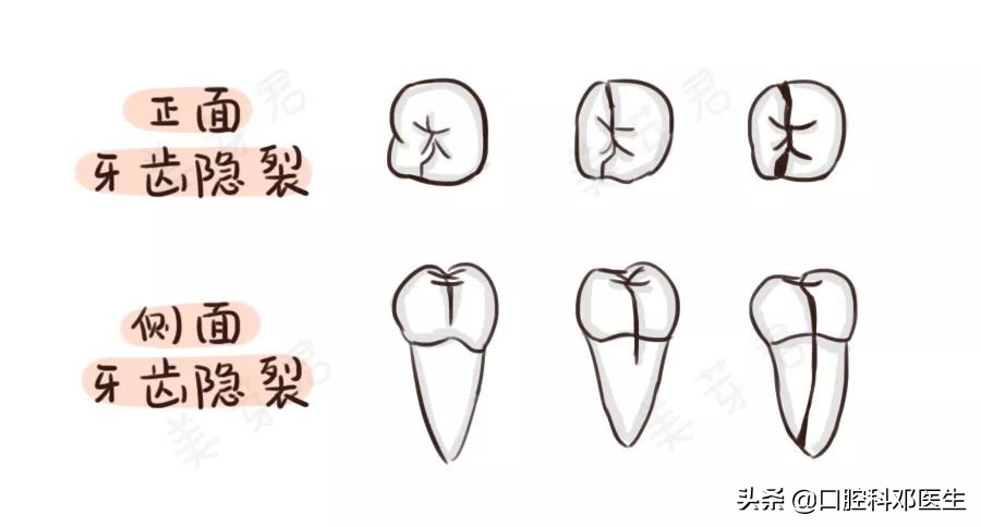 疫情后牙齿怎么修复好一点,新冠肺炎有牙齿方面的症状吗