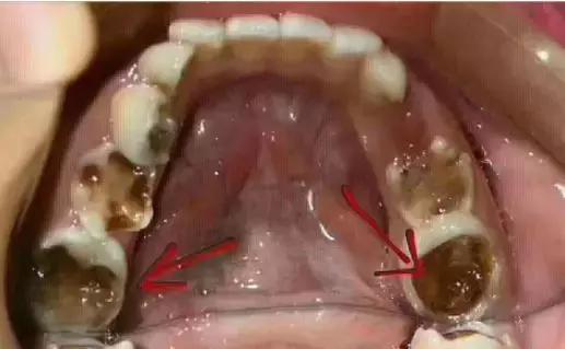 吓！10岁小孩就要靠假牙吃饭，妈妈记住这9招保护好孩子的牙