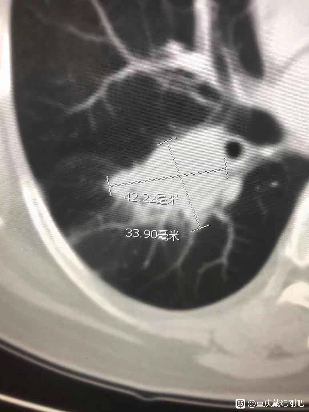 肺癌晚期一副中药活了五年真的吗,一天要三千块以上的治疗费