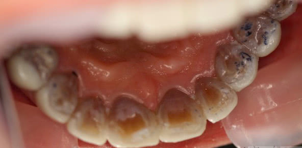 四环素牙治疗方法哪种效果好,四环素牙是树脂好还是陶瓷好