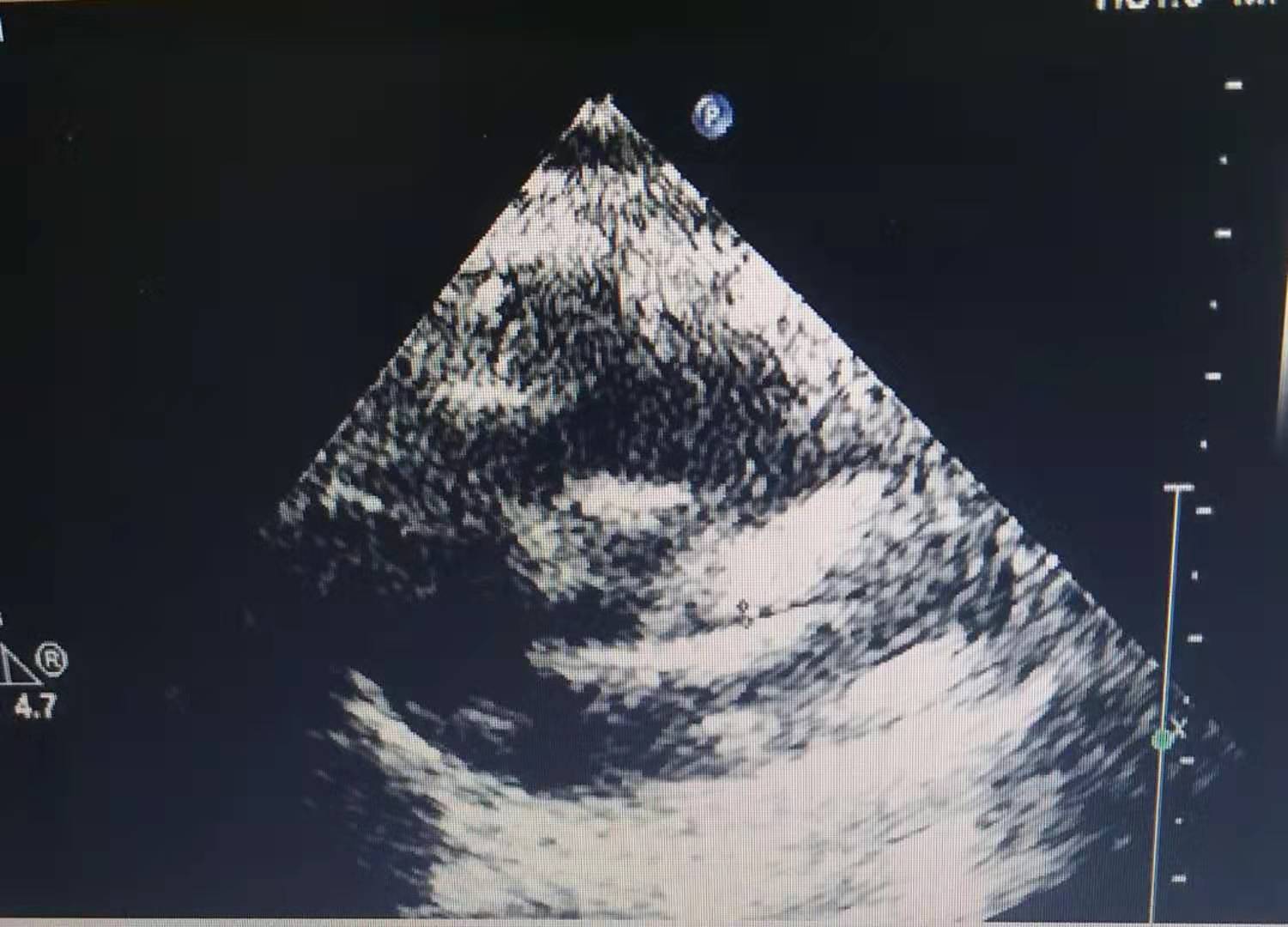 患儿川崎病好转后发烧感冒怎么办,川崎病治愈后娃娃腹泻是怎么回事