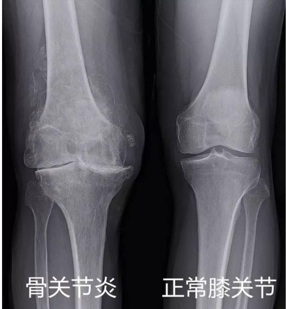 膝关节骨性关节炎的治疗,什么是膝关节骨性关节炎阶梯治疗