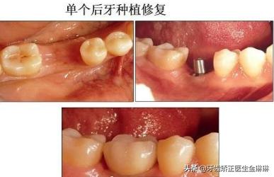 后牙做烤瓷牙冠还是全瓷牙冠,后槽牙做全瓷牙冠会不会掉