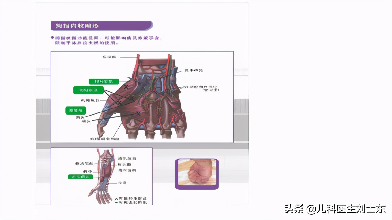 肉毒素治疗脑瘫患儿成功案例,肉毒素治疗脑瘫肌肉痉挛的效果