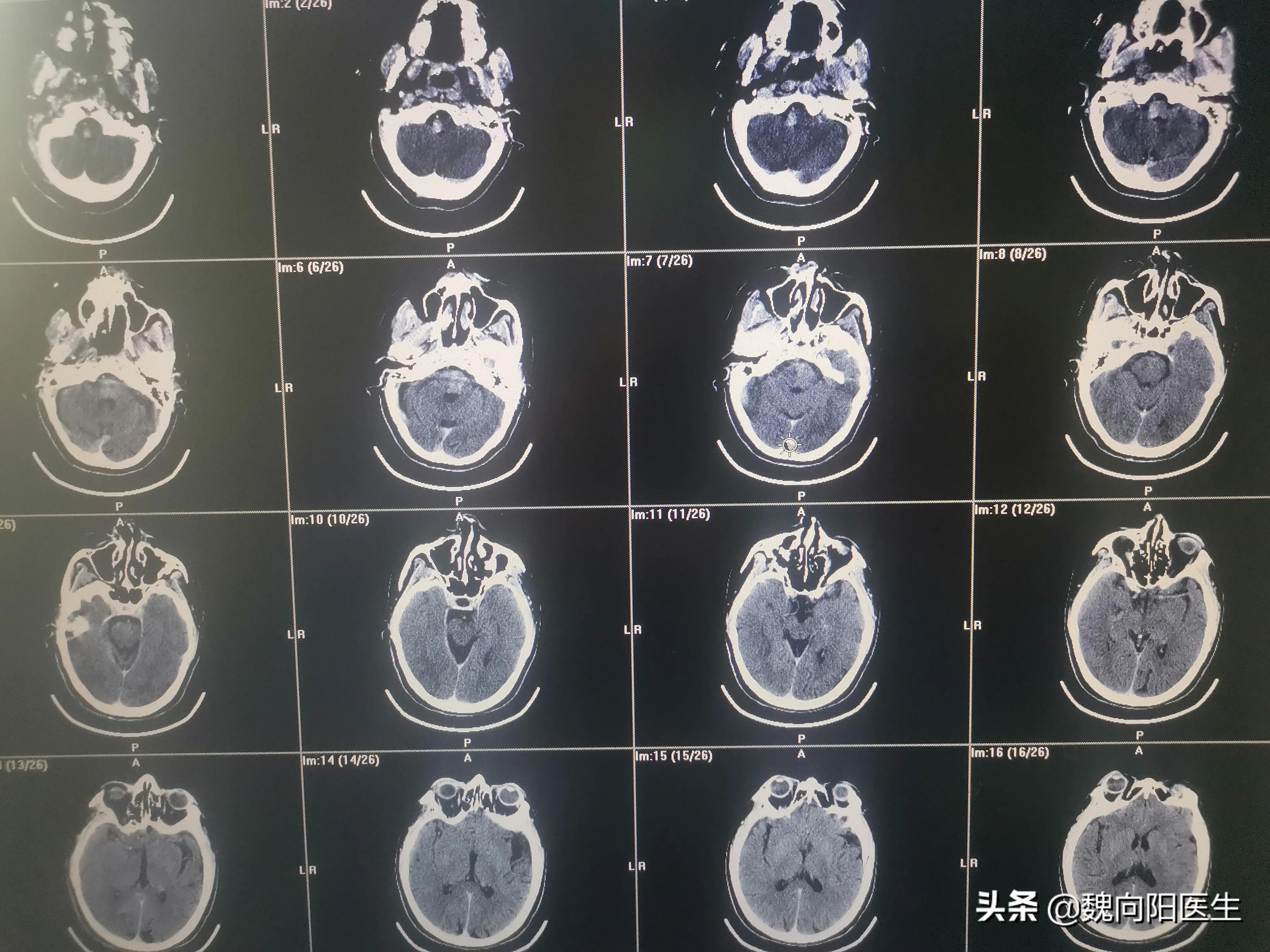 细若头发丝的椎动脉引发严重脑梗塞，开通之后希望早日康复