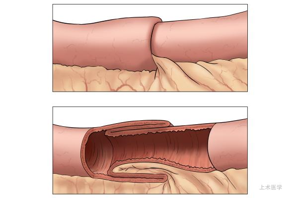 儿童腹痛的十种原因及处理方法