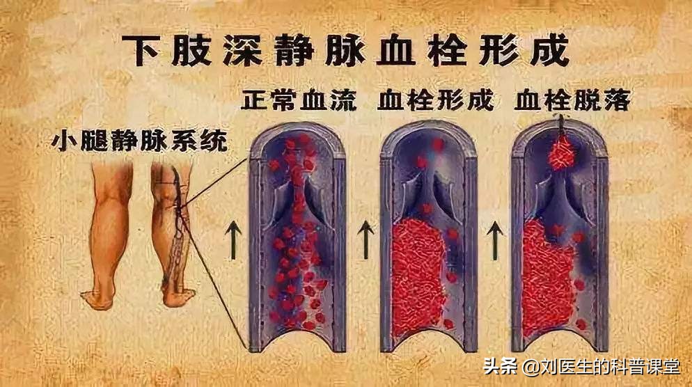 双腿静脉血栓肿怎么治疗,双腿血栓腿肿是什么原因