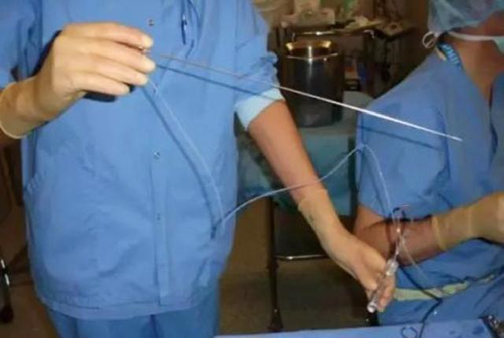 90后夫妻的心酸试管婴儿史，一次取16颗卵泡的过程，回想让人发悸