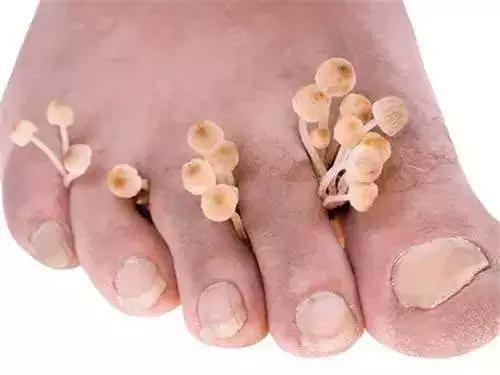 糖友易出现又纠结的8种皮肤病变，医生来支招