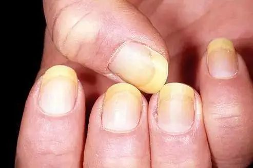 指甲上长斑点是身体发出求救信号,指甲上有皱纹有什么信号求救