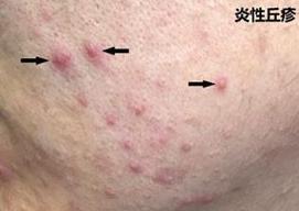 痘痘防止复发的方法是什么,反复长痘怎么解决改善痘痘肌