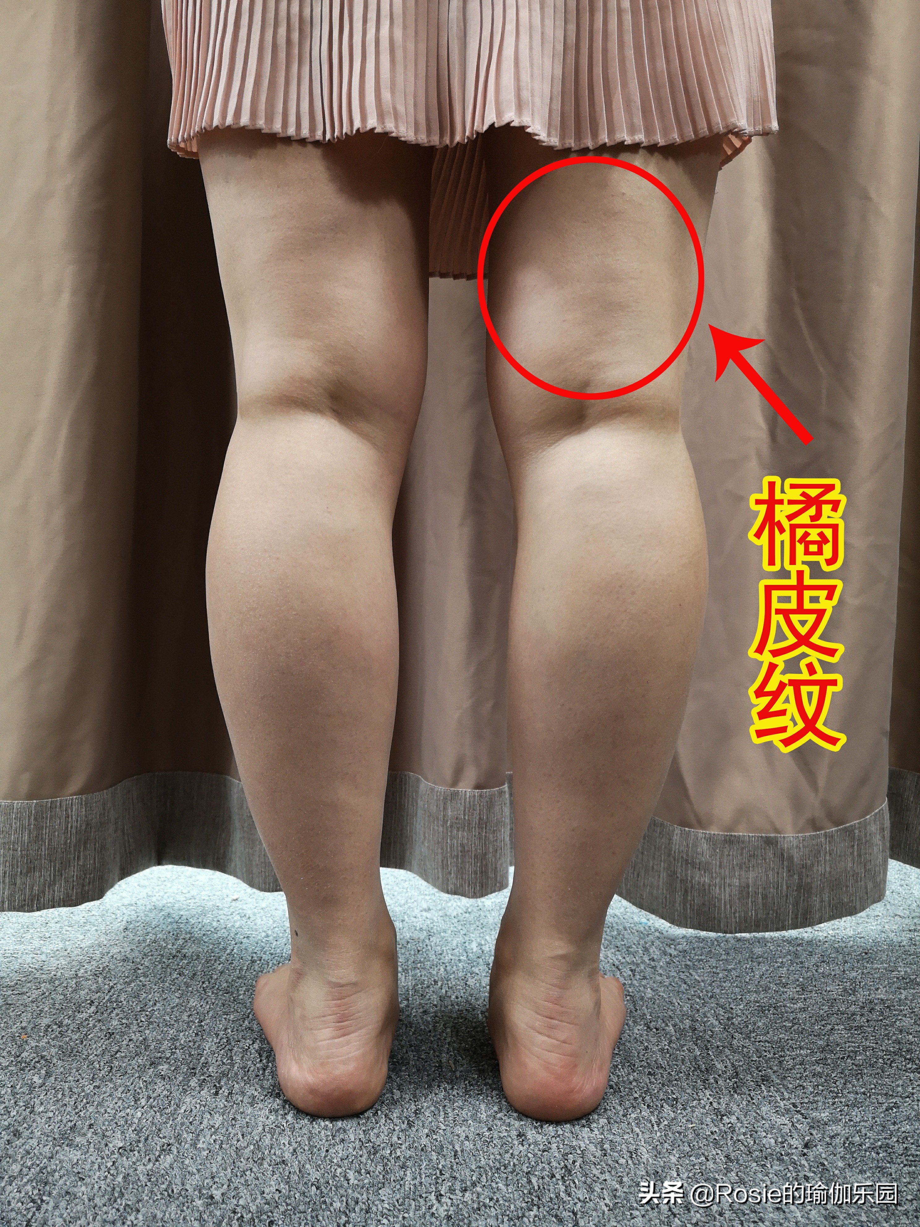 大腿上的肉肉怎么捏,大腿肉一捏好多凹凸不平怎么回事