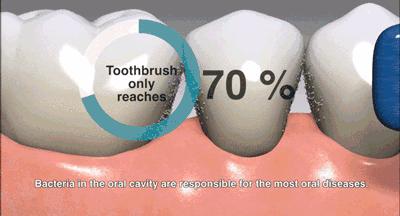 3岁儿童全麻做根管有影响吗,宝宝捆绑治疗蛀牙