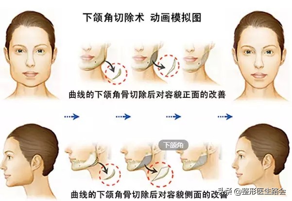 下颌角整形│对不起，你的脸让我的心好“方”