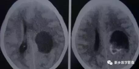 颅内有钙化怎么治疗,34岁脑部有钙化正常吗