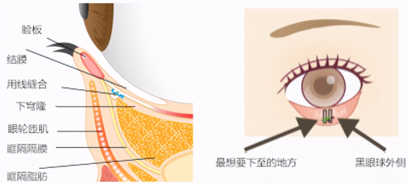 关于下睑下至，到底做还是不做？美之峰解灿告诉你