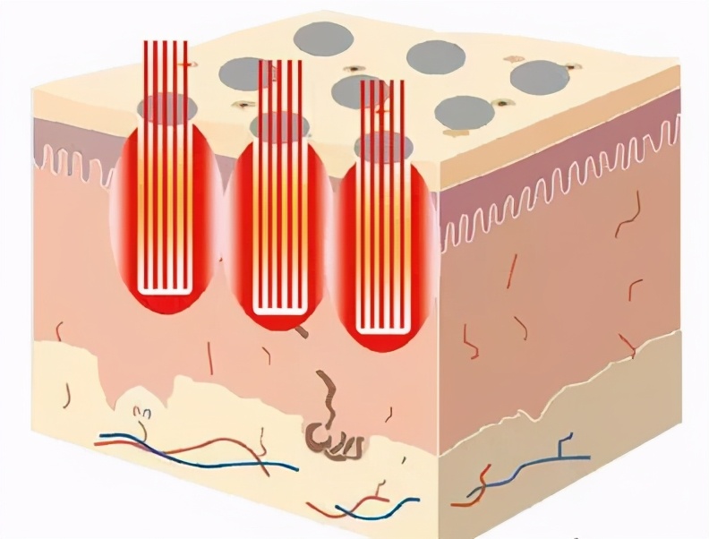 t区毛孔粗大还能收缩回去吗,毛孔粗大用护肤品能收缩回去吗