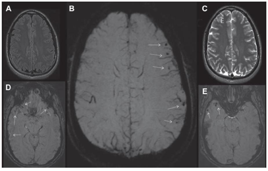 头疼做磁共振脑小血管有点出血,核磁共振说脑血管出血