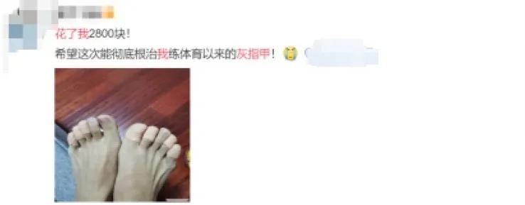 治疗灰指甲到底要花多少钱,激光治疗灰指甲多少钱