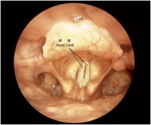如何知道咽炎还是喉癌,我们如何才能知道自己得了喉癌呢