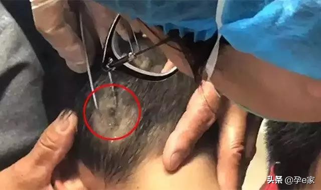 身上出现许多小黑痣,身上出现凸起黑痣一定要重视