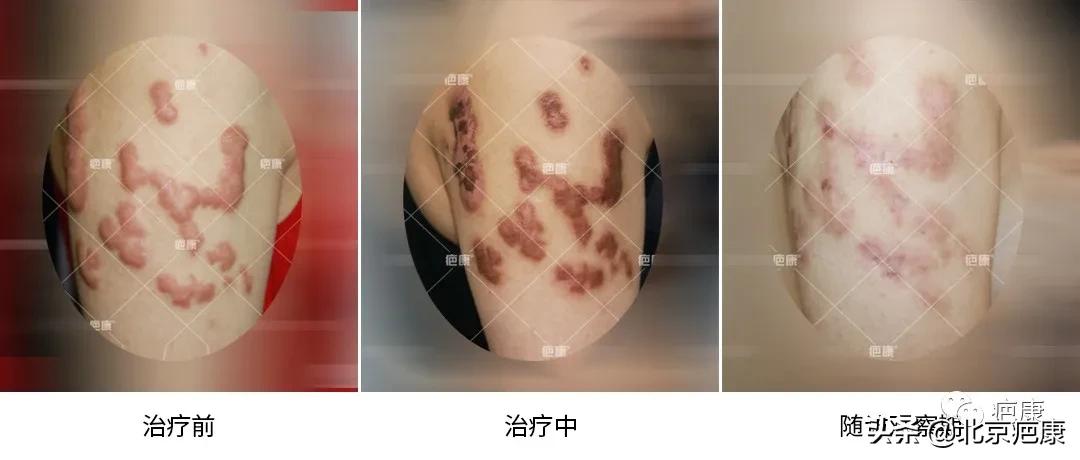 看到最后,为什么每个治疗中的人对疤友的建议都一样?