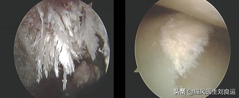 痛风石能不能手术取出,取痛风石手术是不是得消肿才能做