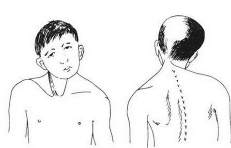 孩子总是歪头看电视,孩子总是歪头睡怎么办