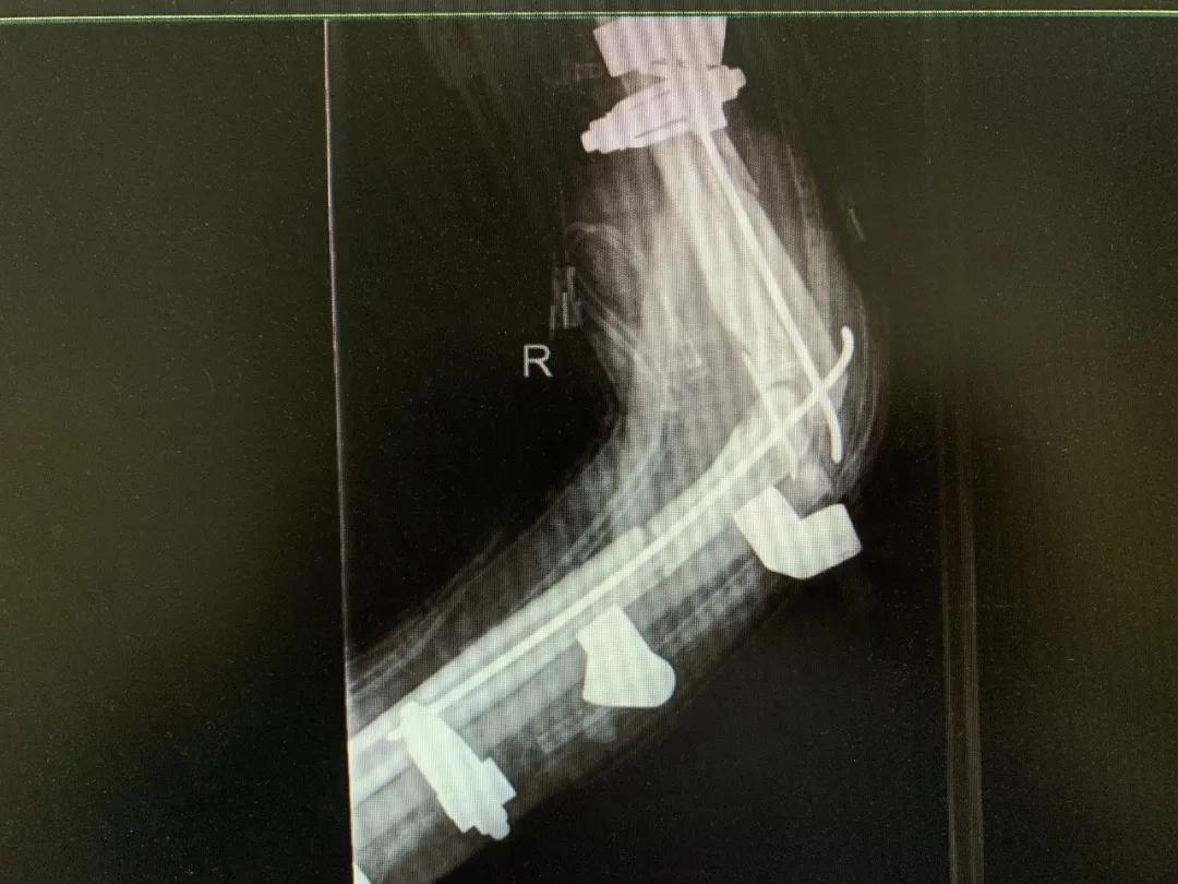 【日照市人民医院】右臂卷入机器被撕裂　6.5小时成功复活