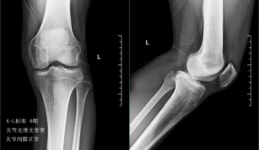 关节炎可以通过打抗生素治疗吗,关节炎治疗的注意事项