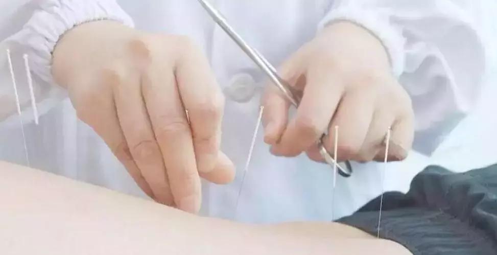 针灸治疗疼痛的偏方,针灸治疗腰疼痛的偏方