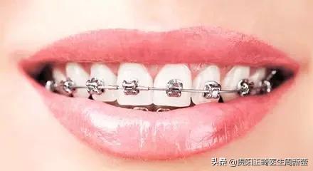 三种牙套大PK，优势对比一目了然