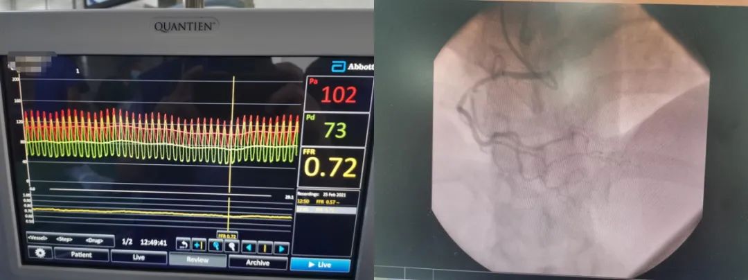 ffr心内科,为冠心病介入治疗提供中国方案