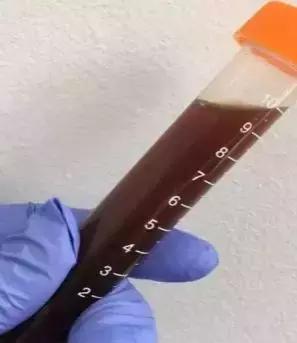 9岁女孩尿出“酱油”，只因体育课做了……记住这几点关键时能救命！