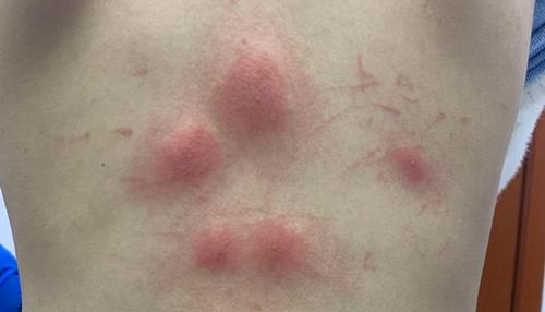 奇痒难忍的红疙瘩很大凸起,奇痒无比的红疙瘩怎么办