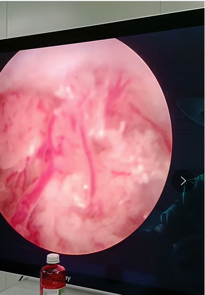 2岁女童*体下**出血一查竟是乳头状瘤