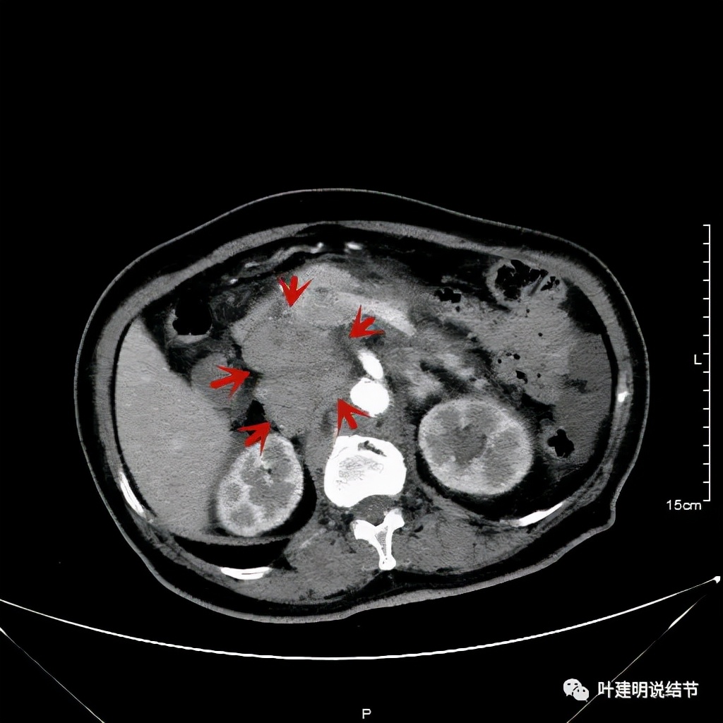 特瑞普利单抗食管癌成功案例,特瑞普利单抗治疗食管癌效果好吗
