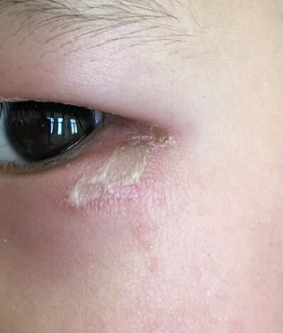 儿童脚上被虫咬起水泡图片,女童手脚起水泡怎么回事