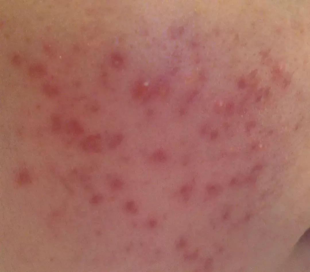 痘印很顽固怎么祛痘印,痘印祛痘药膏