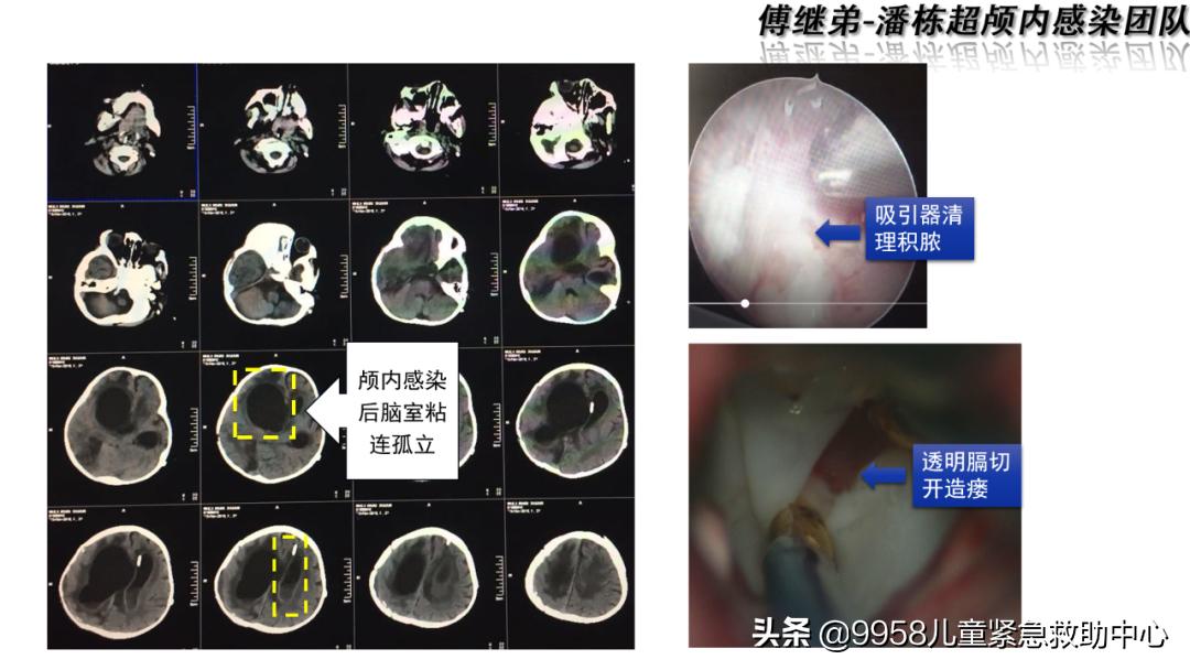 颅内感染康复治疗知识,小儿颅内感染的健康宣教