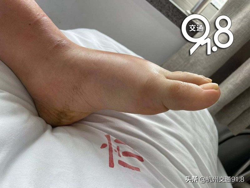 因为脚气！杭州女白领送医救治十几天