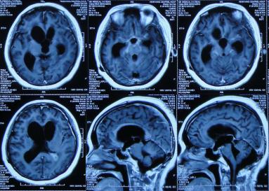 结核性脑积水,脑膜炎脑积水要治疗多久