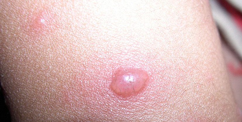 水痘的讲解,关于水痘科普小知识视频