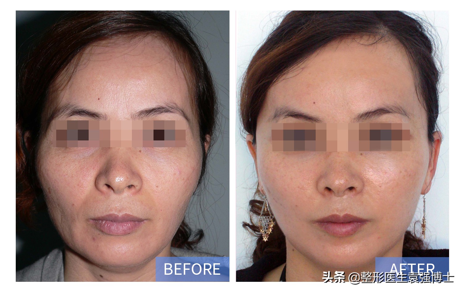 法令纹真正有效的方法,法令纹用什么方法解决比较好