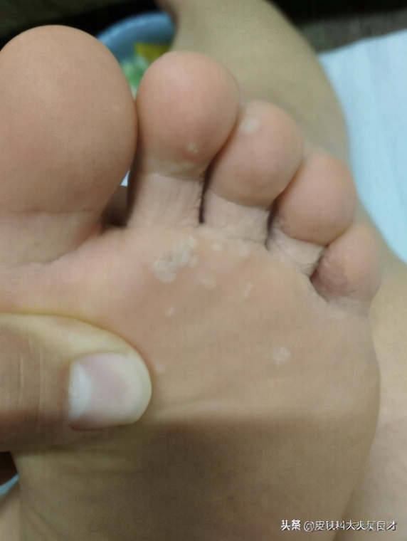 初期鸡眼和跖疣的区别,鸡眼和跖疣最简单的区别