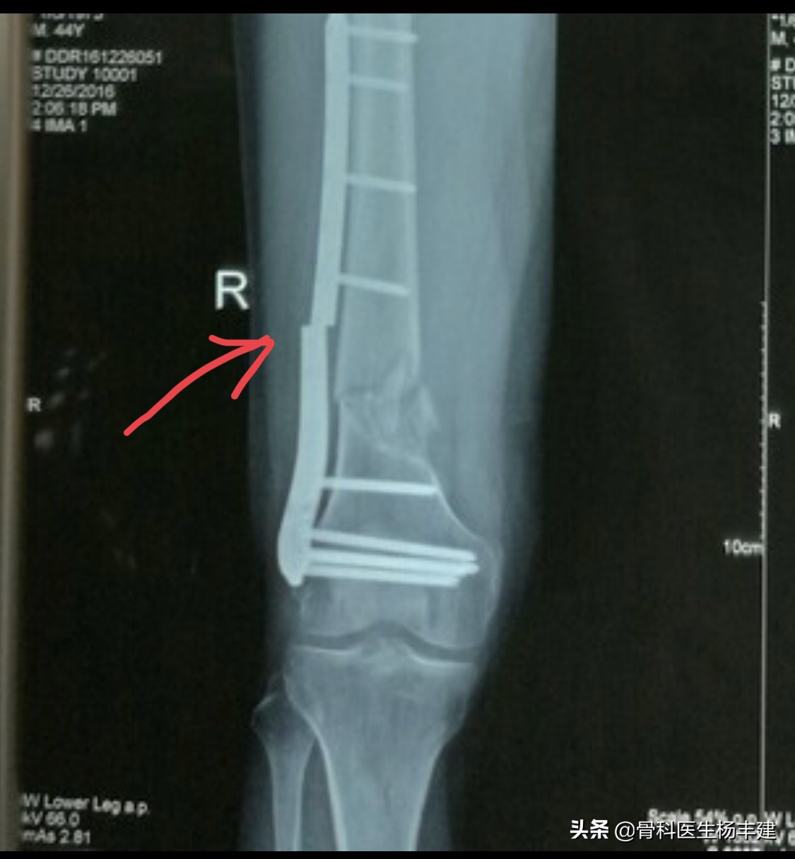 锁骨骨折后钢板断裂怎么办,股骨骨折钢板断裂原因分析