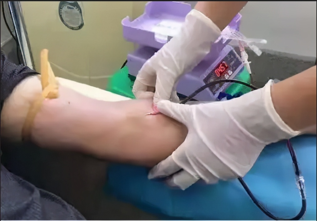 三氧大自血疗法在疼痛科的运用,天津哪个医院有自血疗法