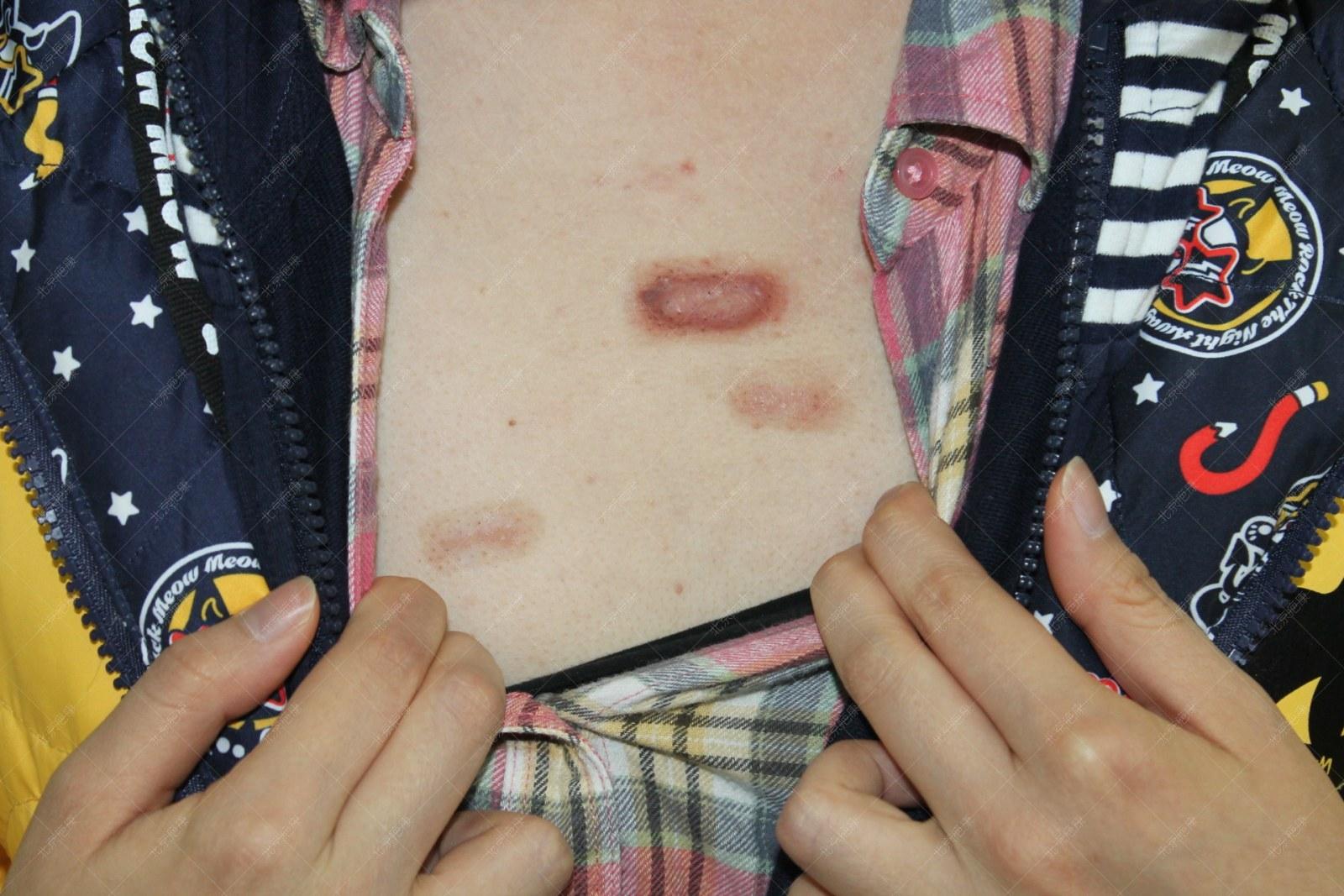 北京疤康怎么治疗疤痕,疤康医院治疗疤痕增生如何